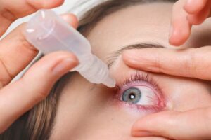 What is Primary Congenital Glaucoma (PCG)?