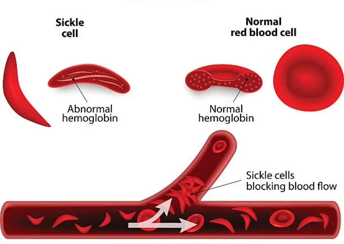 gene therapy for the treatment of sickle cell disease